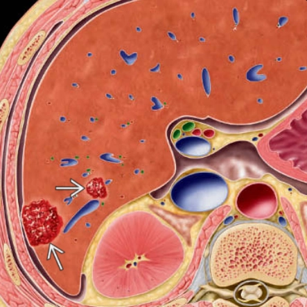 U máu gan (Hepatic Hemangioma / Hepatic Venous Malformation)