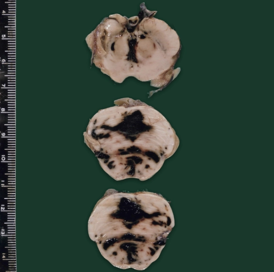 Xuất huyết Duret (Duret hemorrhages)