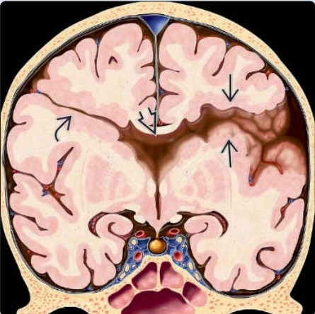 Chẻ não (Schizencephaly)