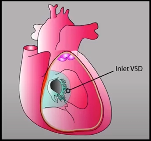 Thông liên thất phần nhận (Inlet VSD)
