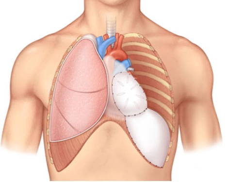 Phẫu thuật cắt toàn bộ phổi (Pneumonectomy)