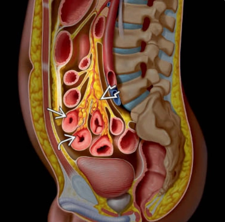 Bệnh Crohn (Crohn Disease)