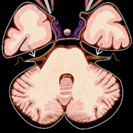 Nhiễm sắt bề mặt kinh điển (Superficial Siderosis, Classical- SS)