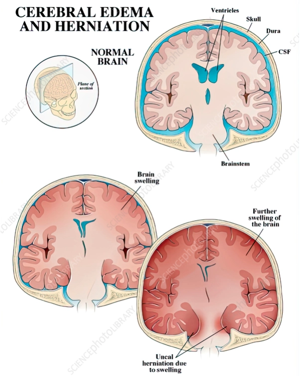 Phù não (Cerebral Edema)