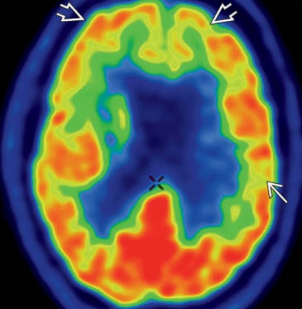 Bệnh Alzheimer (Alzheimer Disease)