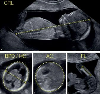 Các mặt cắt siêu âm dị tật thai quý I