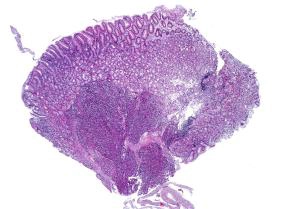 Mô tụy lạc chỗ (Ectopic Pancreatic Tissue)