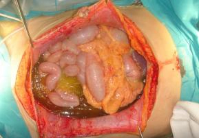 U giả nhầy phúc mạc (Pseudomyxoma peritonei - PMP)