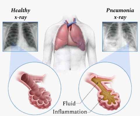 Viêm phổi do tụ cầu (Staphylococcal Pneumonia)