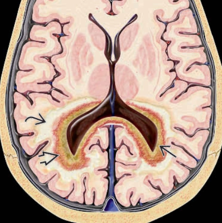 Bệnh loạn dưỡng chất trắng thượng thận liên kết nhiễm sắc thể X (X-linked Adrenoleukodystrophy)