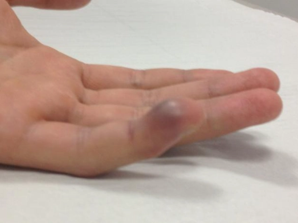 Ngón tay Jersey (Jersey finger)