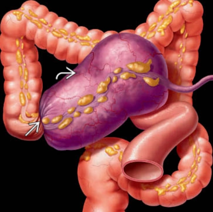 Xoắn manh tràng (Cecal volvulus)