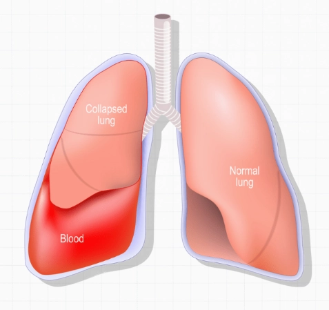 Tràn máu màng phổi (Hemothorax)