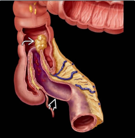 Lồng ruột  (Intussusception)