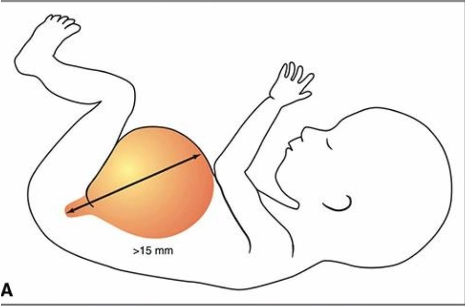 Nang trong ổ bụng thai quý I