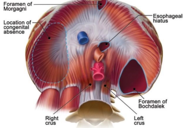 Thoát vị Bochdalek (Bochdalek Hernia)
