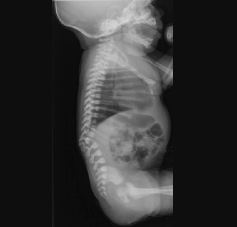 Gù, vẹo cột sống (Kyphosis, Scoliosis)
