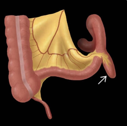 Túi thừa Meckel (Meckel Diverticulum)