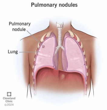 Nốt phổi (Pulmonary Nodules)