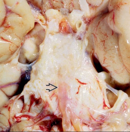 Nang biểu bì nội sọ (Intracranial epidermoid cysts)