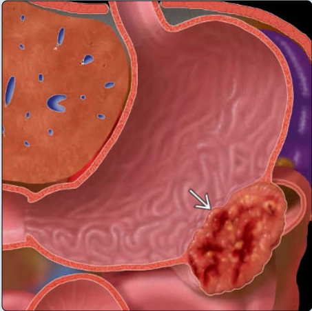 U mô đệm đường tiêu hóa (Gastrointestinal stromal tumor - GIST)