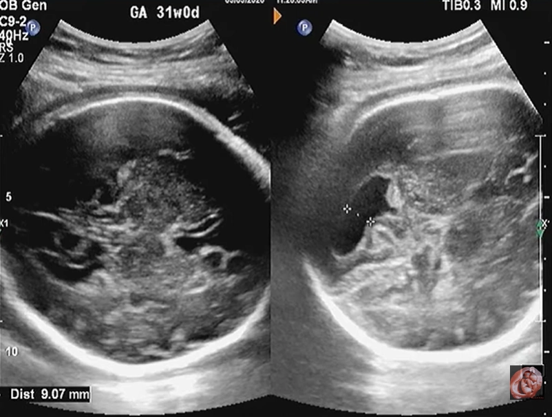 Loạn sản khu trú đầu trên xương đùi thai nhi (Proximal Focal Femoral Deficiency - PFFD)