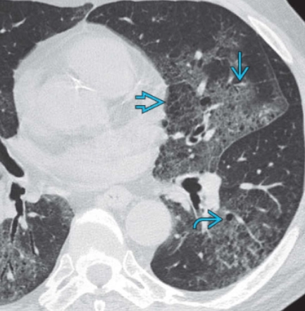 Viêm phổi kẽ tróc vảy (Desquamative interstitial pneumonia - DIP)