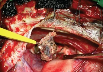 Hệ thống phân độ dị dạng động-tĩnh mạch não Spetzler-Martin (Spetzler-Martin arteriovenous malformation grading system)