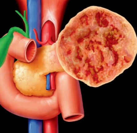 U đặc giả nhú của tụy (Solid Pseudopapillary Neoplasm - SPN)