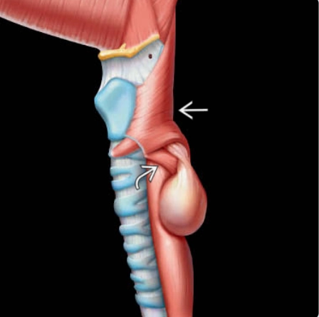 Túi thừa zenker (Zenker diverticulum)