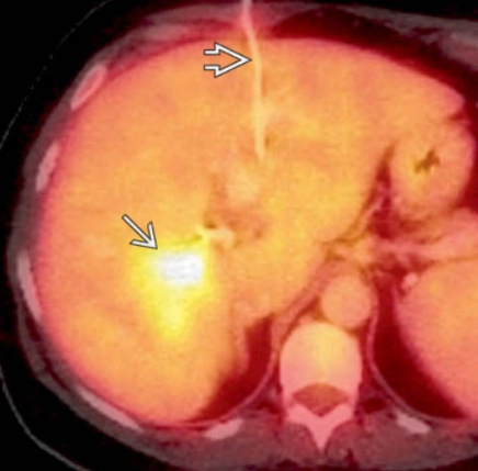 Viêm giả u ở gan (Hepatic Inflammatory Pseudotumor - IPT)