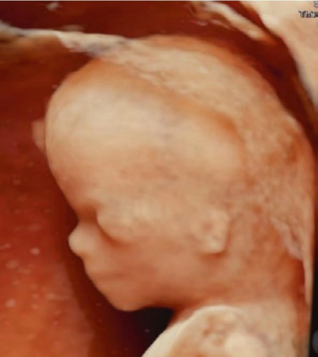 Phôi thai và Giải phẫu siêu âm mặt cổ thai nhi (Embryology and Anatomy of the Face and Neck)