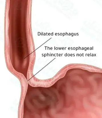 Co thắt tâm vị thực quản (Esophageal Achalasia)