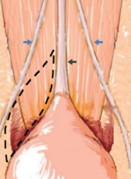Thoát vị trên bàng quang (Internal Supravesical Hernia)