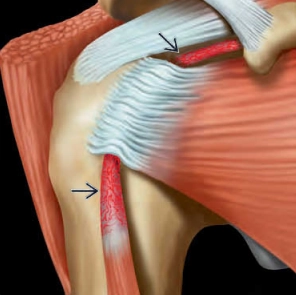 Viêm gân cơ nhị đầu (Biceps Tendinopathy, Shoulder)