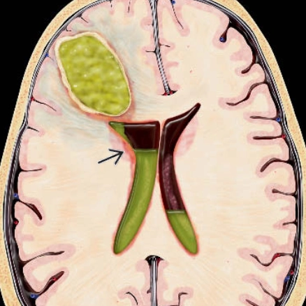 Viêm não thất (Ventriculitis)