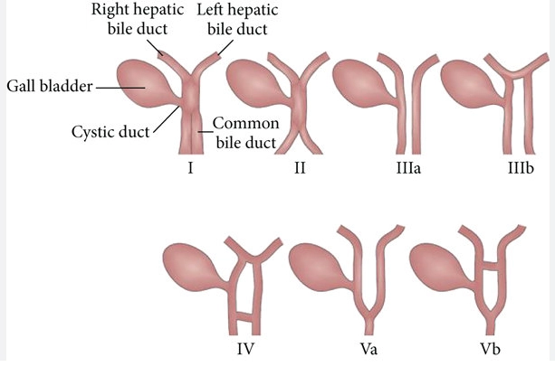 Ống mật đôi (Bile duct duplication)