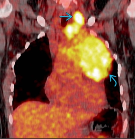 Lymphoma trung thất (Mediastinal lymphoma)