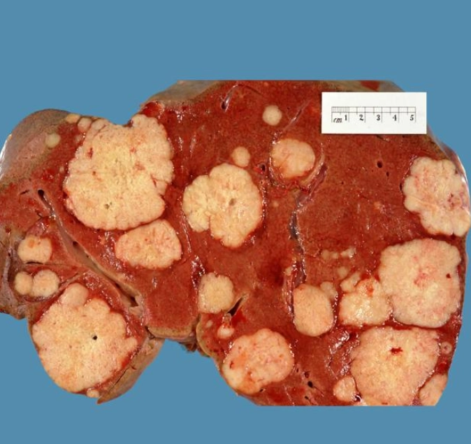 Di căn gan (Hepatic Metastases)