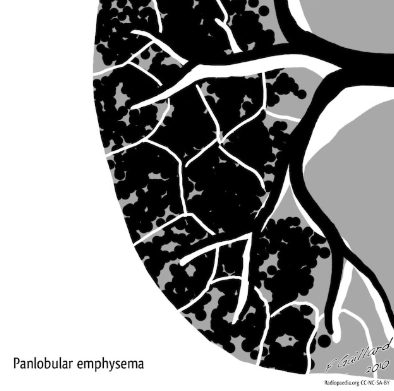 Khí phế thũng toàn tiểu thùy (Panlobular Emphysema)