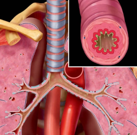 Bệnh phổi tắc nghẽn mạn tính (Chronic obstructive pulmonary disease - COPD) 