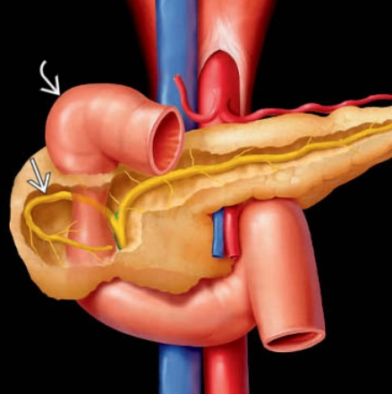 Tụy vòng/ Tụy hình nhẫn (Annular pancreas)