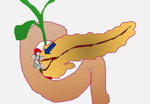 Viêm tụy rãnh tá tụy/ Viêm tụy cạnh tá tràng (Groove Pancreatitis)