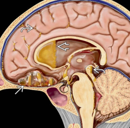 Nang bì nội sọ (Intracranial dermoid cysts) 