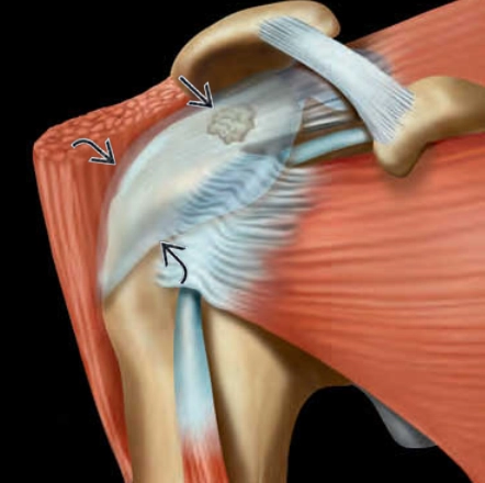 Viêm gân vôi hóa chóp xoay (Calcific tendinitis)