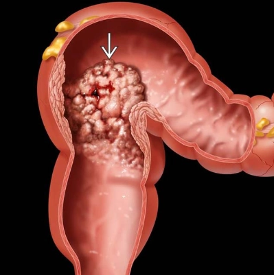 Polyp nhung mao đại trực tràng (Colorectal villous polyps)