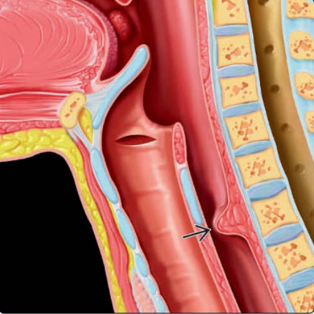 Rối loạn cơ nhẫn hầu (Cricopharyngeal Achalasia)
