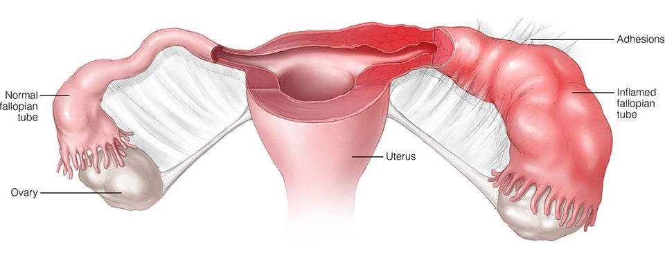 Áp xe vòi trứng - buồng trứng (Tubo-ovarian abscess)