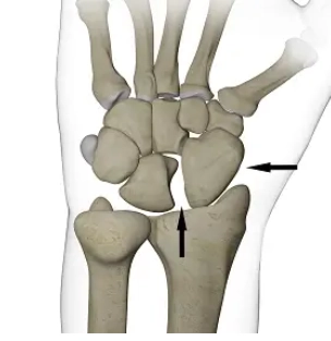 Mất vững thuyền-nguyệt (Scapholunate dissociation)