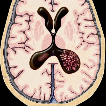 U nhú đám rối mạch mạc (Choroid Plexus Papilloma)